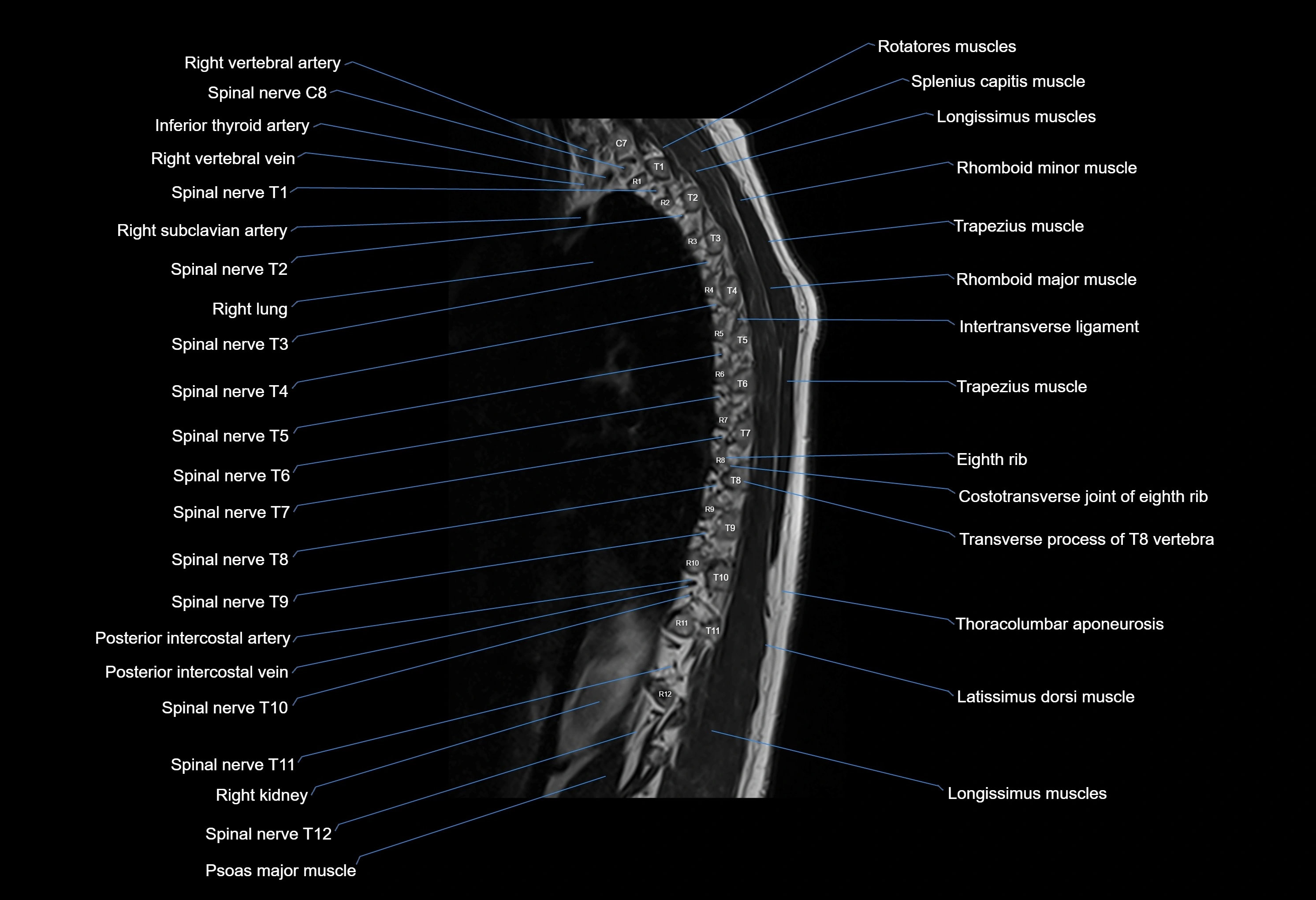 MRI thoracic spine sagittal  cross sectional anatomy 3T radiology  image-img-00001-00002.webp